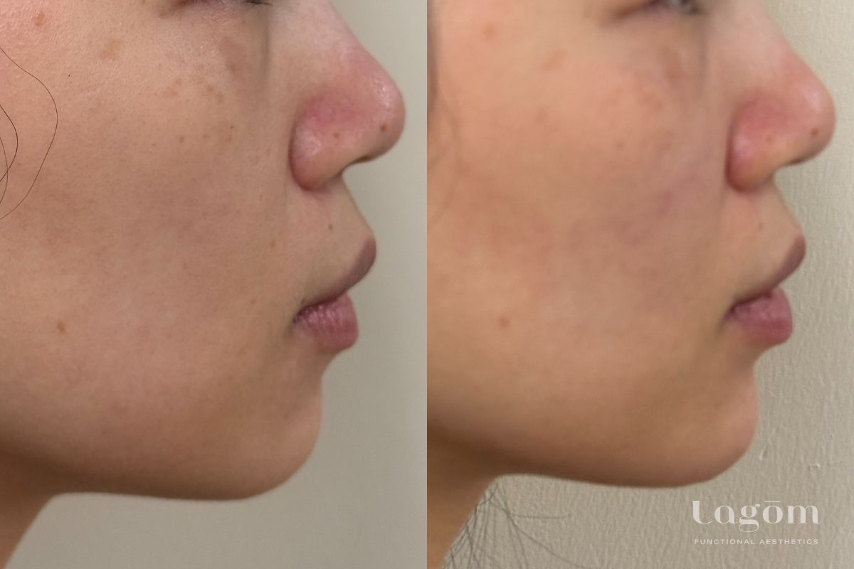 Chin Filler before and after