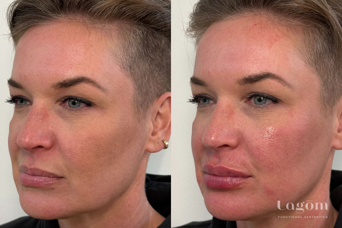 Lip filler before and after
