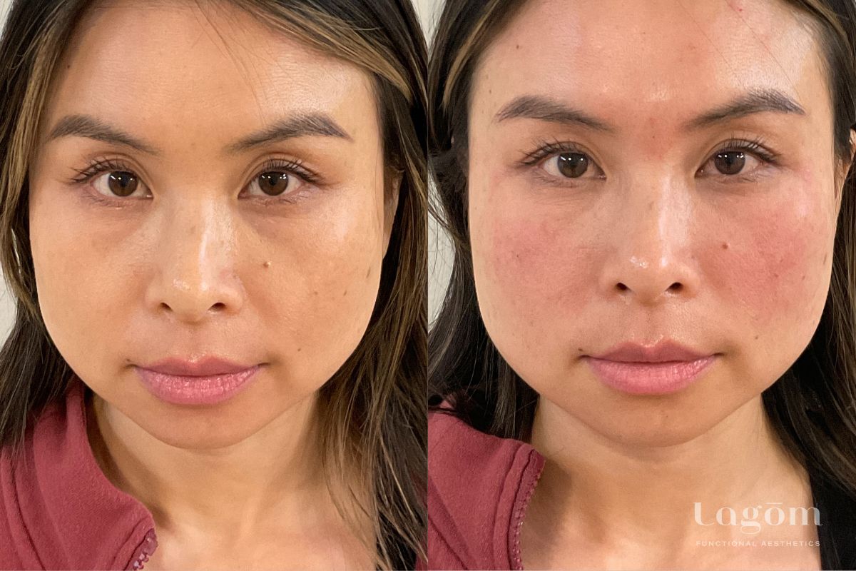 Under eye filler before and after