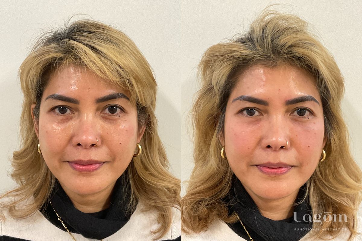 Under eye filler before and after
